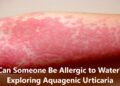 Can Someone Be Allergic to Water? Exploring Aquagenic Urticaria