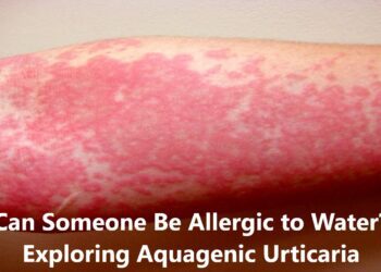 Can Someone Be Allergic to Water? Exploring Aquagenic Urticaria