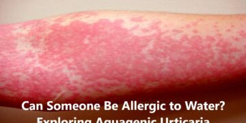 Can Someone Be Allergic to Water? Exploring Aquagenic Urticaria